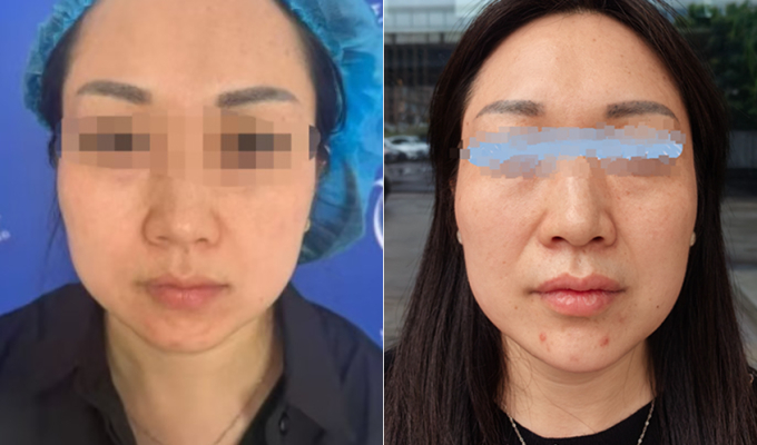 Cô Vương trước và sau khi tiêm chất làm đẹp.